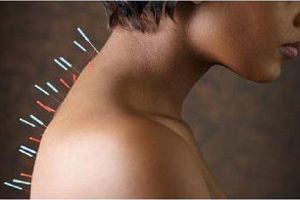 5 Potret Tya Aristya saat lakukan terapi akupuntur