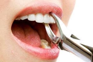 5 Larangan setelah pencabutan gigi, biar nggak tambah sakit