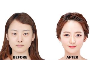 Ini syarat pemotongan tulang area wajah pada oplas ala Korea