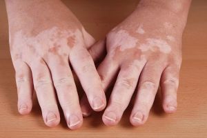 Ini penyebab & gejala vitiligo, penyakit kulit belum banyak diketahui