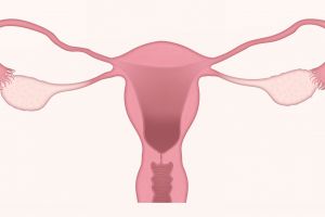 3 Cara sederhana menangani kista ovarium tanpa operasi