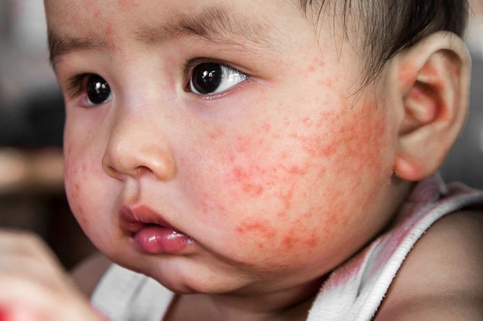 Ini penyebab dermatitis pada bayi, anak-anak, dan orang dewasa