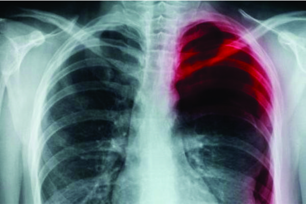 Ini penyebab paru-paru kolaps yang harus diwaspadai