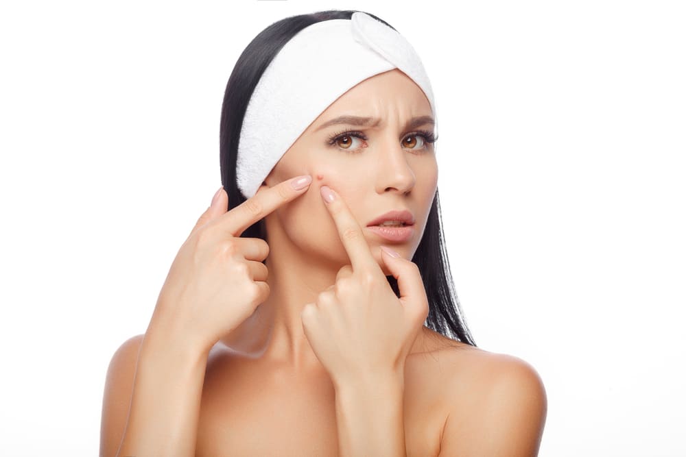 5 Letak jerawat di wajah ini dipengaruhi oleh kondisi kesehatanmu