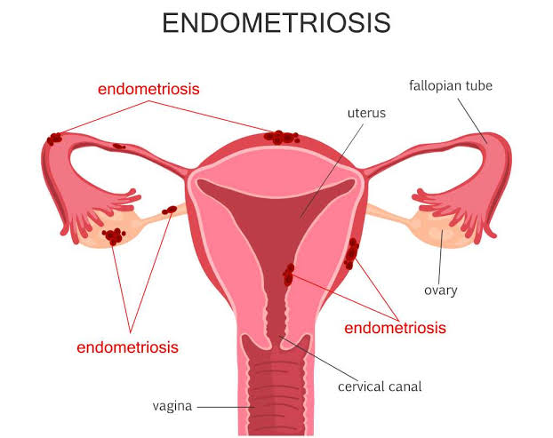 Waspadai endometriosis, tumor dinding rahim yang kerap dikira wasir