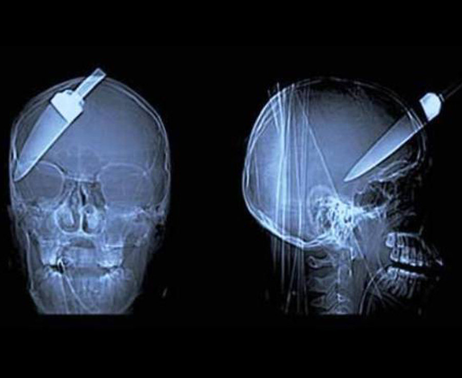 10 Benda aneh ini pernah tertangkap X-Ray ada di tubuh manusia
