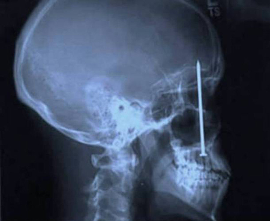 10 Benda aneh ini pernah tertangkap X-Ray ada di tubuh manusia