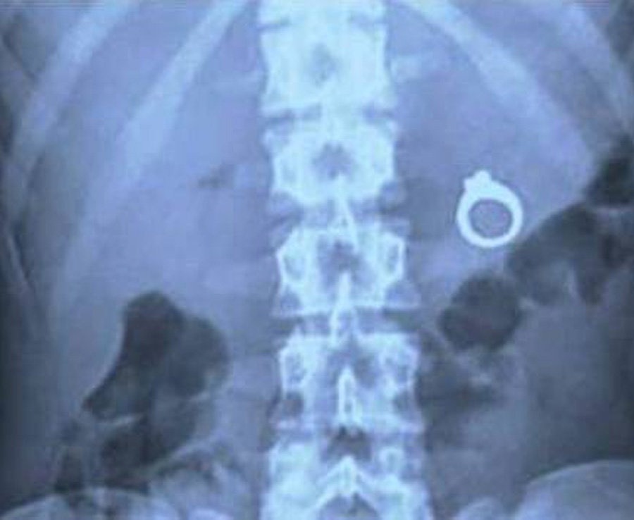 10 Benda aneh ini pernah tertangkap X-Ray ada di tubuh manusia