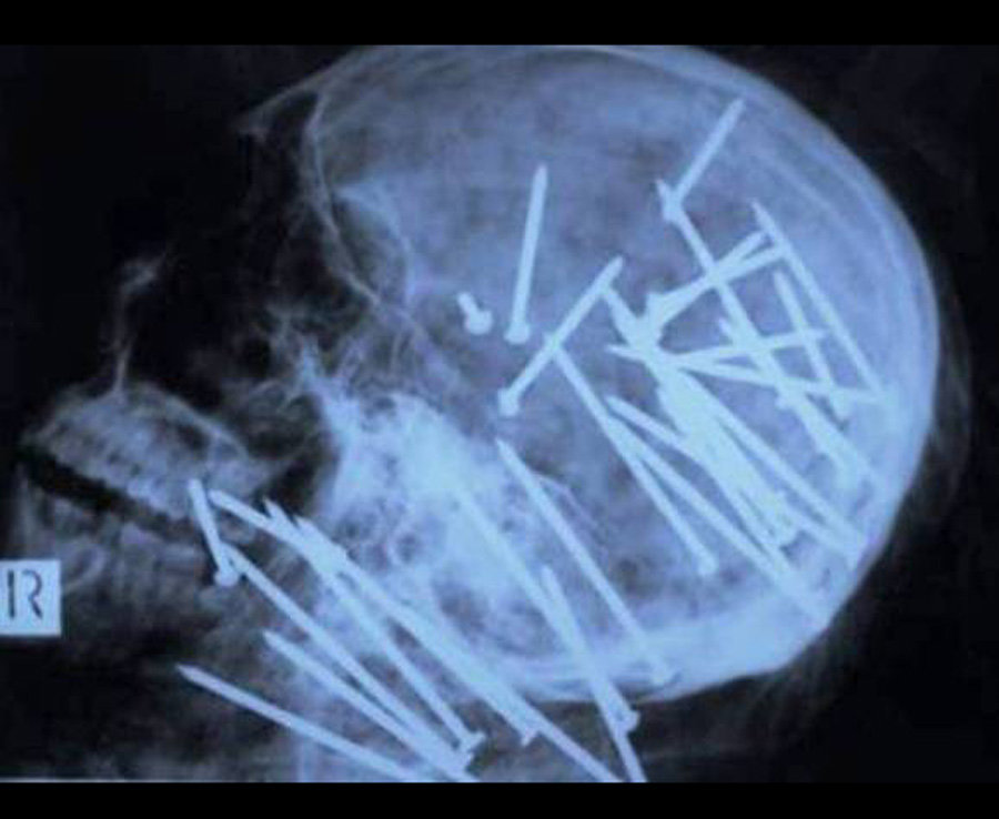 10 Benda aneh ini pernah tertangkap X-Ray ada di tubuh manusia