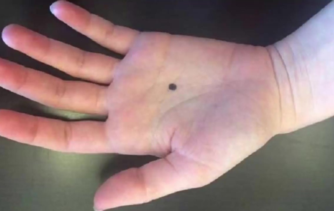 10 Rahasia tersembunyi tahi lalat berdasarkan tempatnya di tubuh