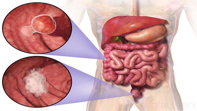 Pengobatan Kanker Usus Yanto Dibantu dengan Ling Shen Yao (Obat Herbal)