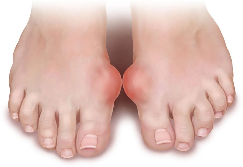 4 Bahan alami untuk meringankan gejala rematik pada kaki