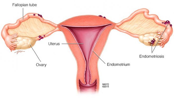 4 Penyakit rahim ini masih bisa diobati tanpa melakukan operasi