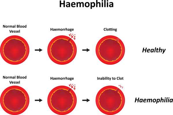 Impaired Blood Vessels