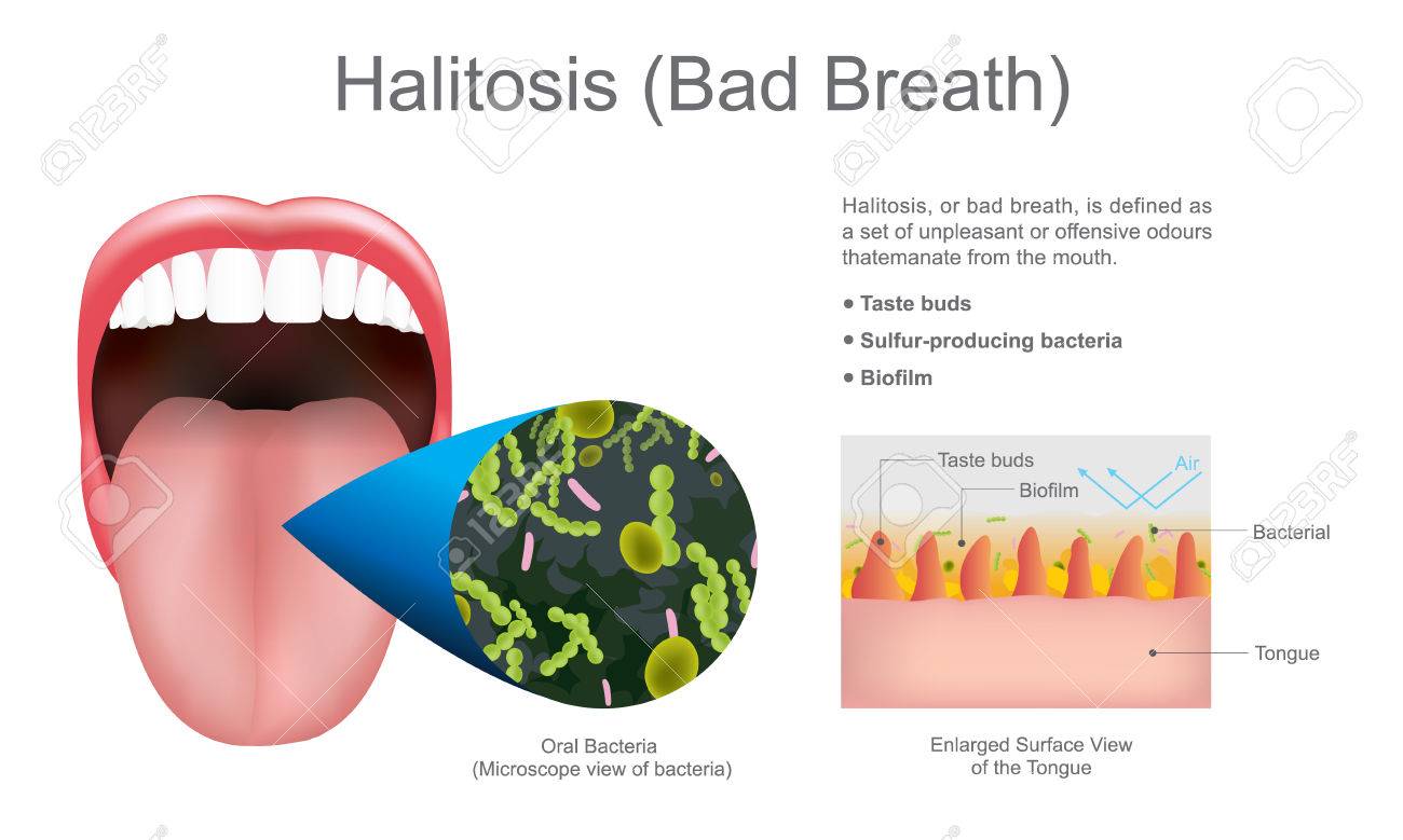 penyebab halitosis
