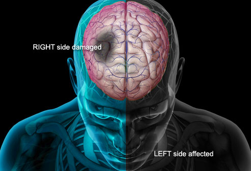 Bisa menyerang tanpa isyarat, kenali lebih dekat penyakit stroke
