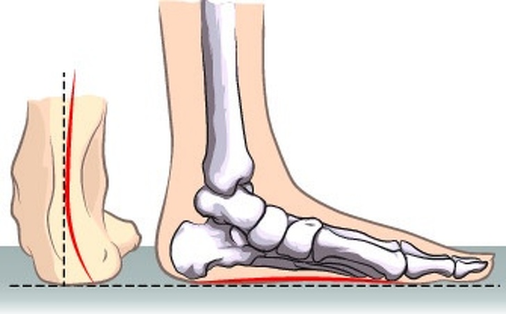 7 Latihan dari ahli tulang ini dapat mengurangi nyeri kaki