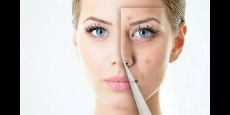 5 Kosmetik yang harus dihindari ketika wajahmu berjerawat