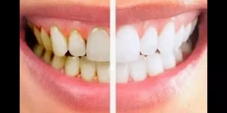 8 Cara menghilangkan karang gigi tanpa harus pergi ke dokter gigi
