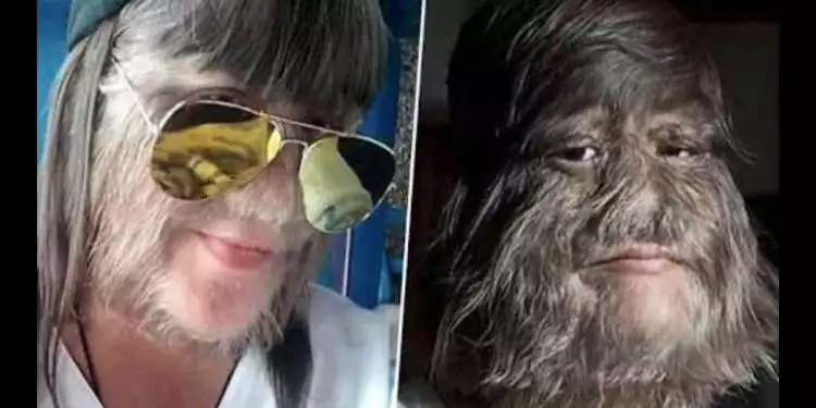 Ini transformasi mengejutkan gadis Thailand yang wajahnya penuh rambut