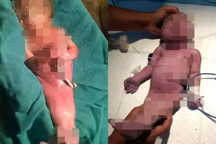 Lahir dengan kelainan genetik, bayi ini kakinya mirip putri duyung