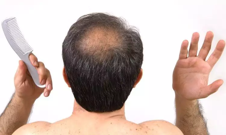 Inilah 4 cara ampuh atasi kebotakan rambut, bisa dicoba nih