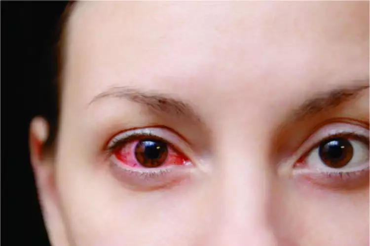 Gunakan 4 cara ini untuk menghindari penularan sakit mata