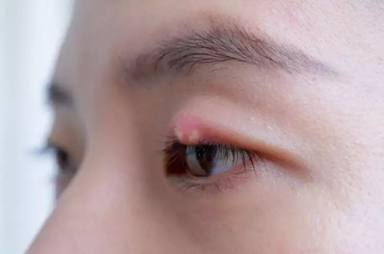 Ini penyebab muncul benjolan pada kelopak mata dan cara mengatasinya