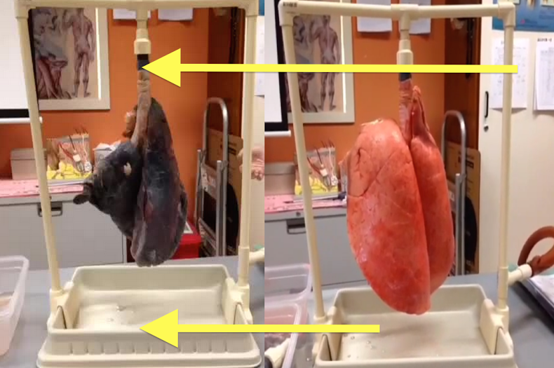 VIDEO: Masih berani merokok setelah melihat paru-paru perokok ini?