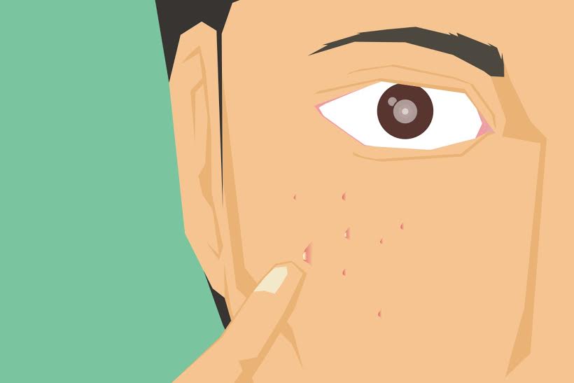 7 Fakta tentang jerawat di wajah yang sering kamu pencetin