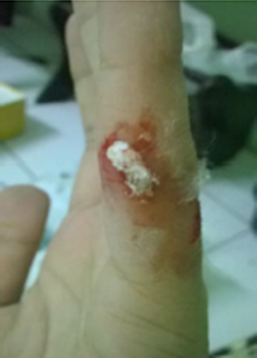 Terinspirasi pengobatan cara lama, sarang laba-laba jadi plester luka