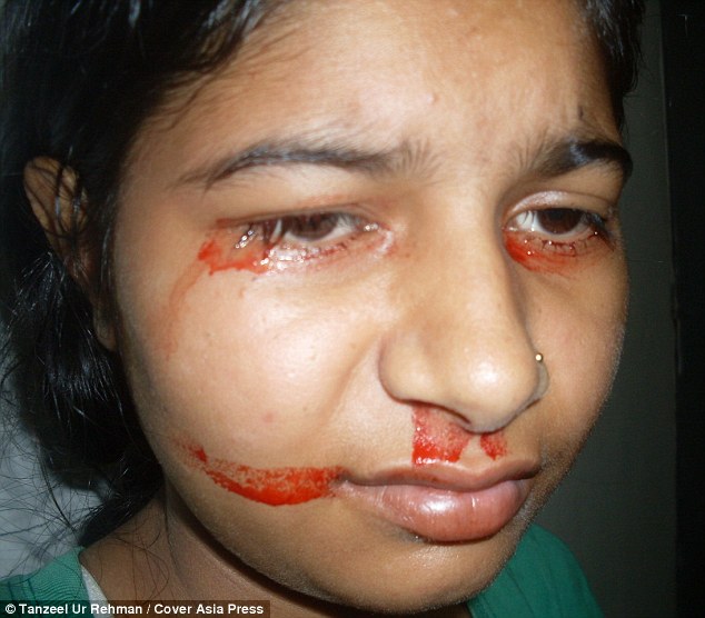 Penyakit langka gadis India, mengeluarkan air mata dan keringat darah