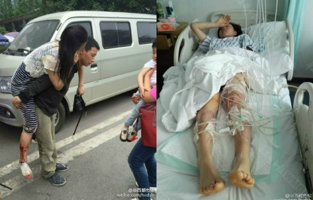 Lindungi bayi, ibu di China terkena 19 gigitan anjing