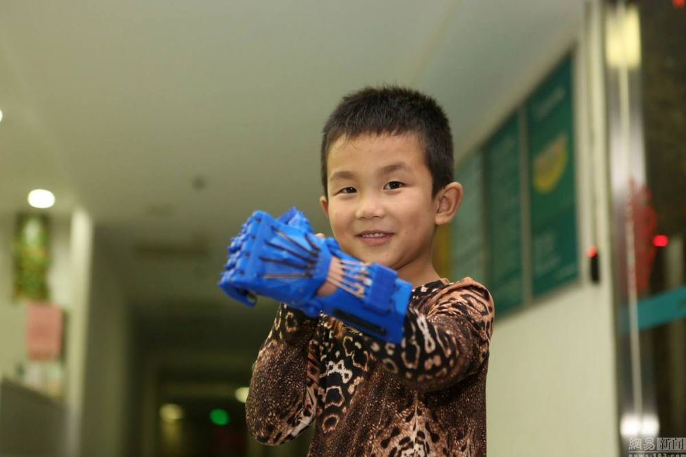 Anak ini tersenyum kembali setelah dipasangkan tangan 3D