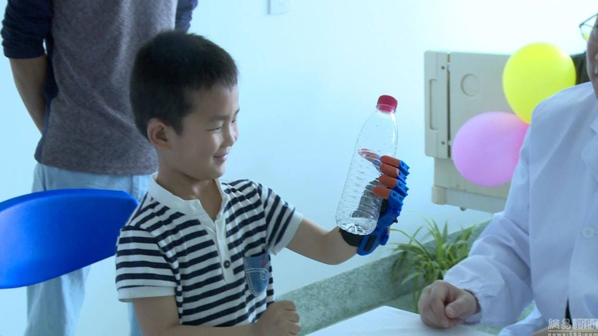 Anak ini tersenyum kembali setelah dipasangkan tangan 3D