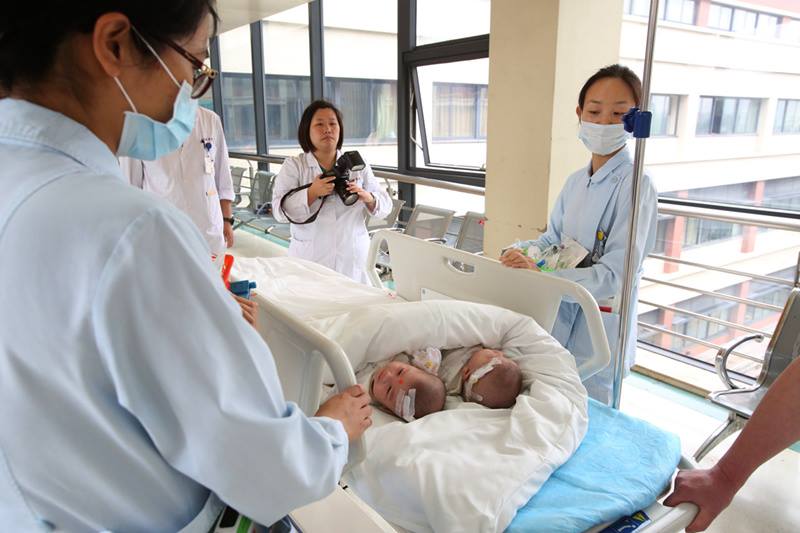 Ini kembar siam pertama yang terpisah berkat bantuan teknologi 3D