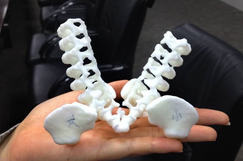 Ini kembar siam pertama yang terpisah berkat bantuan teknologi 3D