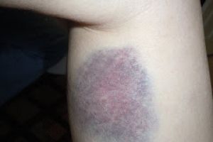 Kulit kamu tiba-tiba memar berwarna biru? Jangan panik, ini sebabnya