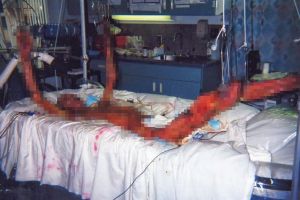 Gambar seramnya efek radiasi pada tubuh manusia