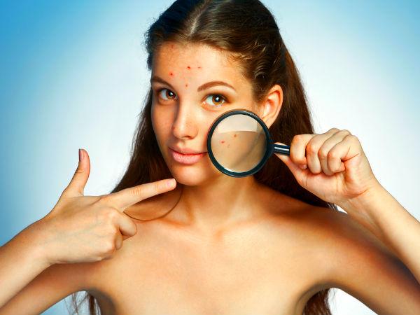 Jangan sepelekan ketombe di rambutmu, bisa buruk efeknya ke kesehatan Jangan sepelekan ketombe di rambutmu, bisa buruk efeknya ke kesehatan