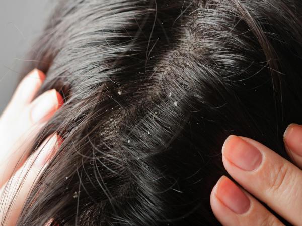 Jangan sepelekan ketombe di rambutmu, bisa buruk efeknya ke kesehatan