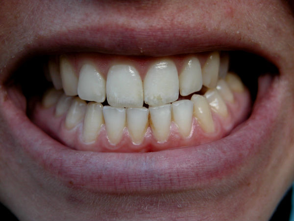 9 Kebiasaan buruk ini bisa merusak gigi kamu, ayo dihindari!