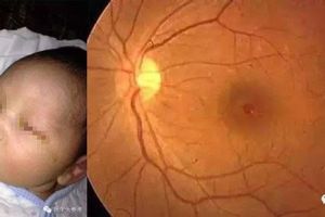 Dokter mata Amerika: Lampu kamera bukan penyebab bayi di China buta