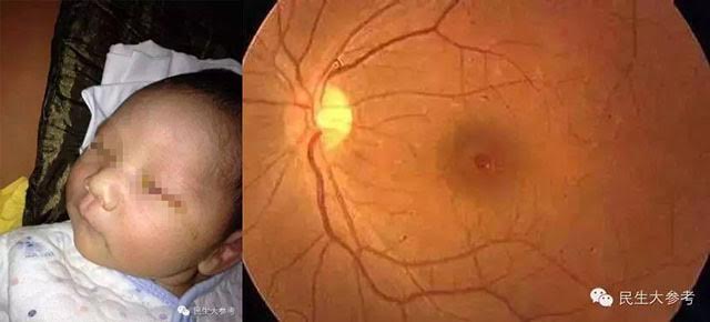 Dokter mata Amerika: Lampu kamera bukan penyebab bayi di China buta