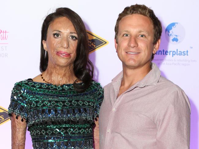 Kisah Turia Pitt, dapatkan cinta sejati meski fisiknya berubah jelek