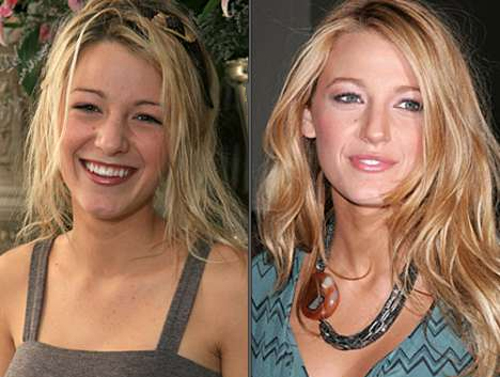 Penampilan 15 selebritis ini jadi menawan setelah operasi plastik