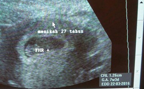27 Tahun menikah, ibu ini baru diberi kesempatan hamil anak pertama 27 Tahun menikah, ibu ini baru diberi kesempatan hamil anak pertama