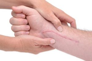 Cara menghilangkan bekas luka pada tubuh