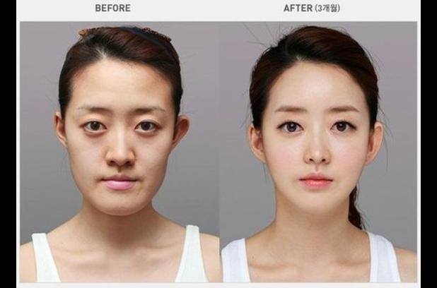 Percayakah kamu 15 foto ini semua hasil operasi plastik?