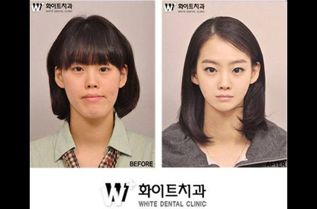 Percayakah kamu 15 foto ini semua hasil operasi plastik?